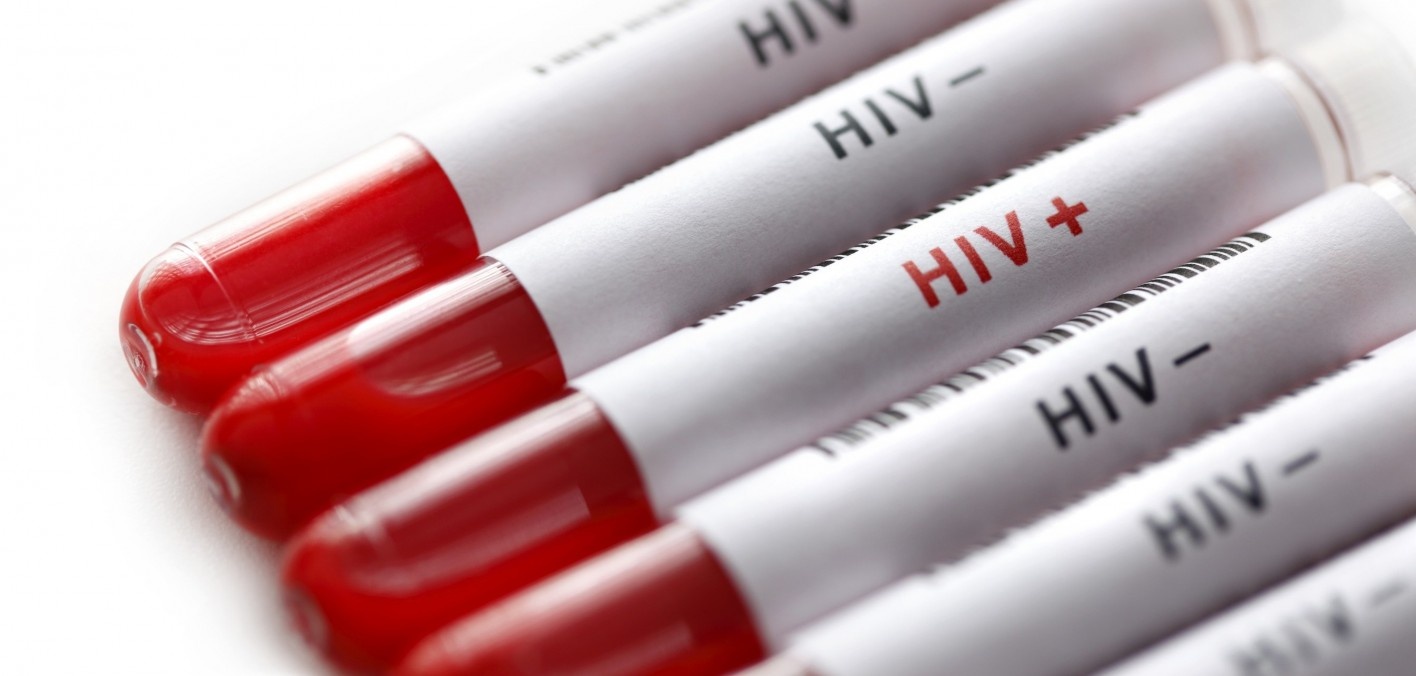 Bệnh nhân nhiễm HIV ảnh 8 Benh nhan nhiem HIV anh 8