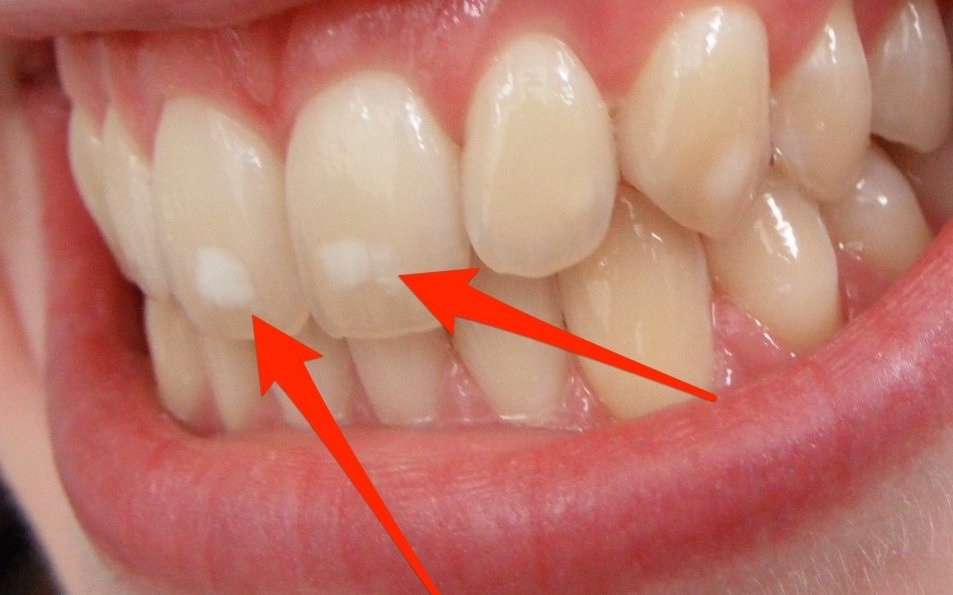 Tai sao ban co nhung cham trang tren rang? hinh anh