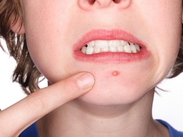 Nhan dien 5 loai mun thuong gap va cach dieu tri hinh anh