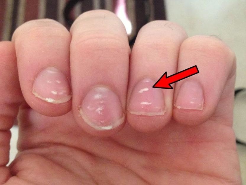 'Hat gao' tren mong tay canh bao benh nguy hiem hinh anh