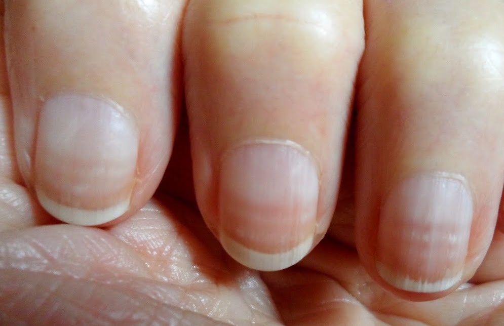 Mong tay bat thuong canh bao van de suc khoe nghiem trong hinh anh