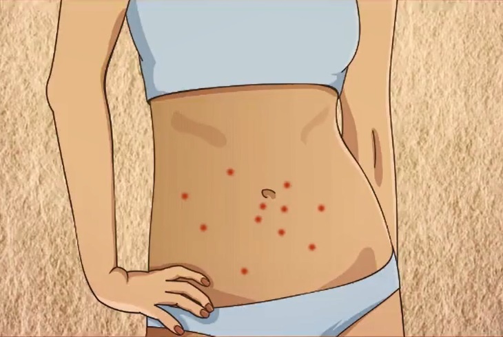 Tu bat benh qua vi tri not mun moc tren co the hinh anh