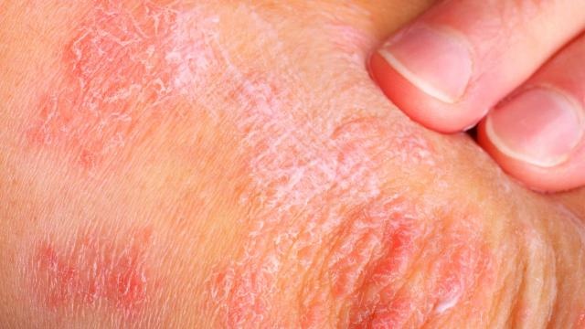 Cách ngăn ngừa bệnh vảy nến ảnh 2 Cach ngan ngua benh vay nen anh 2