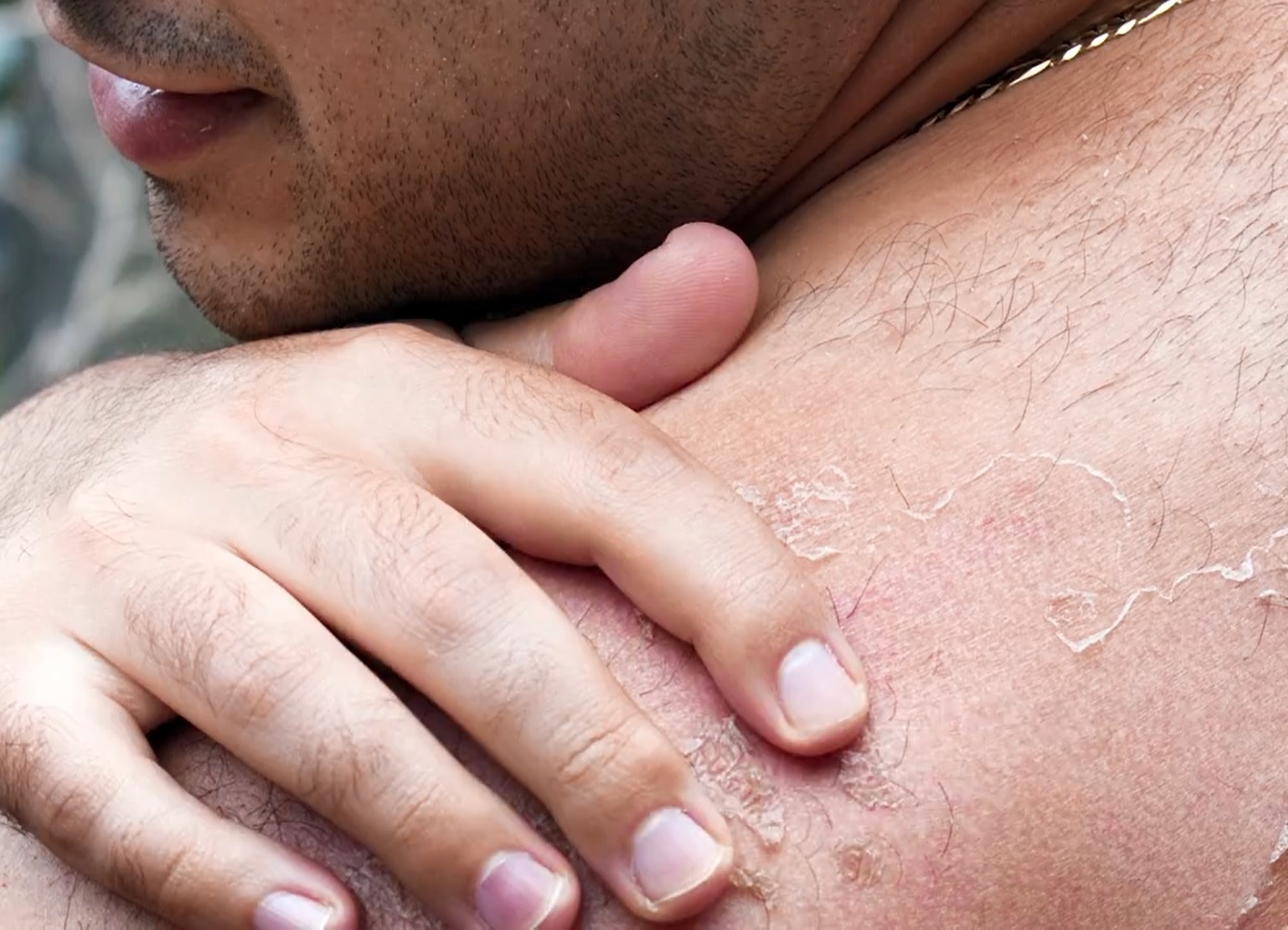 Tai sao da lai bong troc khi bi chay nang? hinh anh