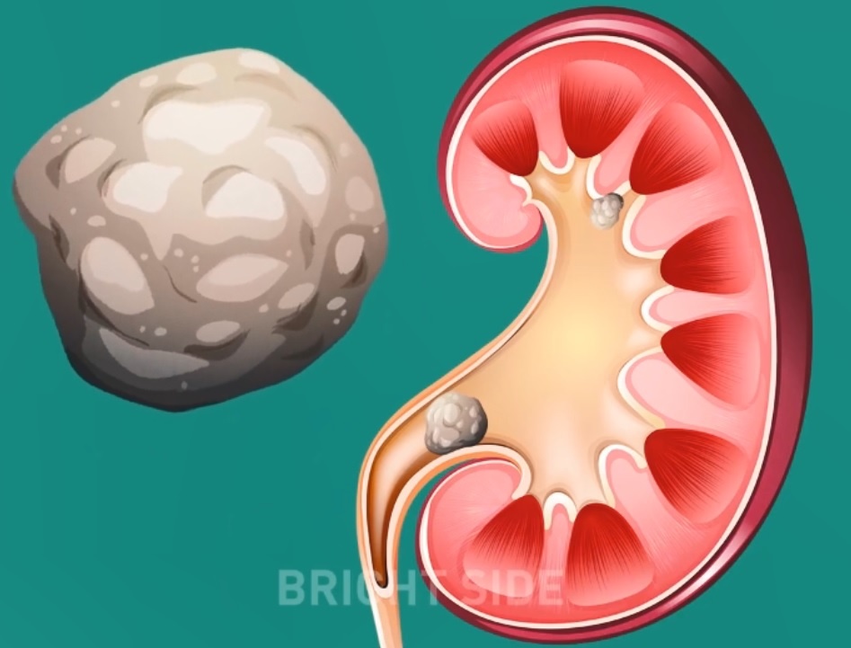 Soi than hinh thanh trong co the nhu the nao? hinh anh