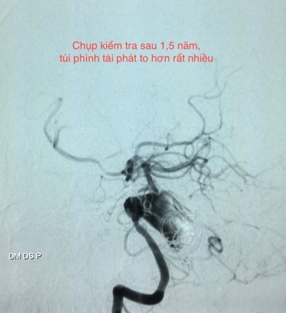 Can thiệp mạch máu não không gây mê ảnh 1 Can thiep mach mau nao khong gay me anh 1