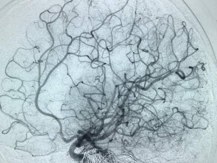 Lan dau can thiep mach mau nao khong can gay me cho benh nhan 15 tuoi hinh anh