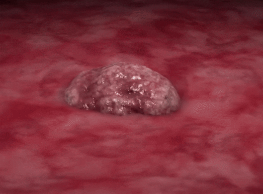 Te bao ung thu di can hoat dong nhu the nao? hinh anh