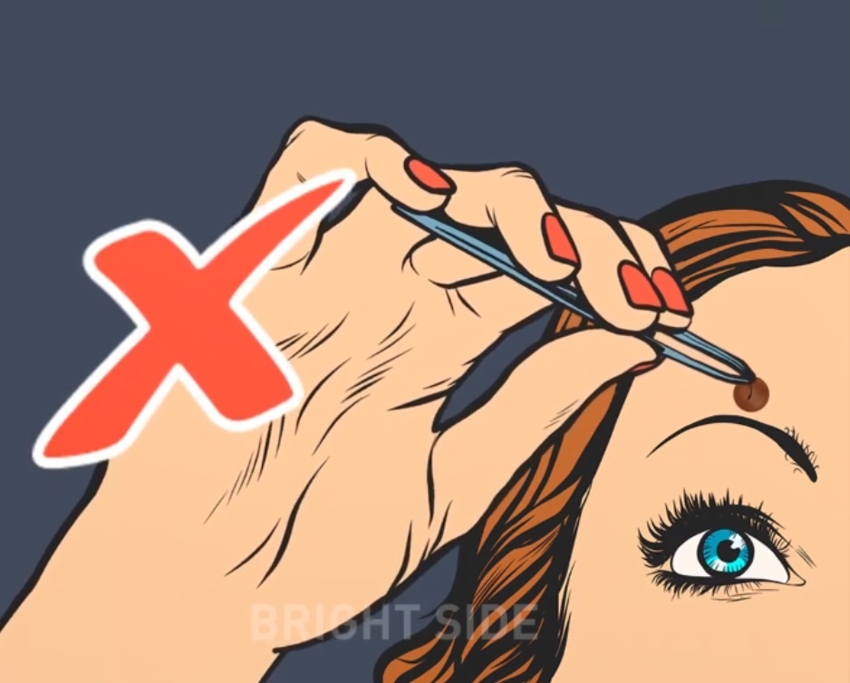 Tai sao ban khong duoc nho long moc o not ruoi? hinh anh