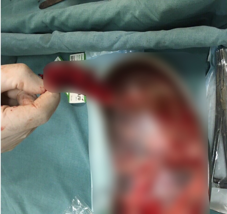 Nguoi phu nu mac khoi u to nhu mang thai 7 thang hinh anh