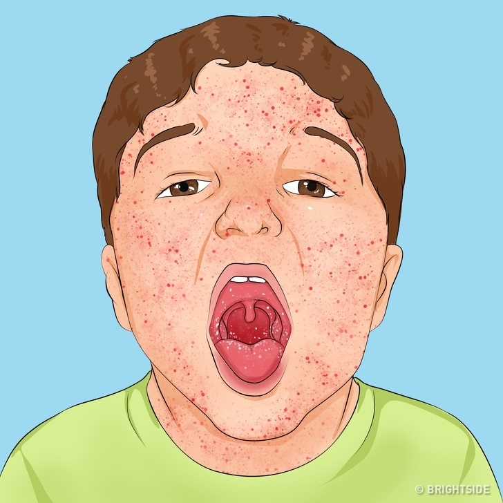 Nhung can benh pho bien o tre anh 9