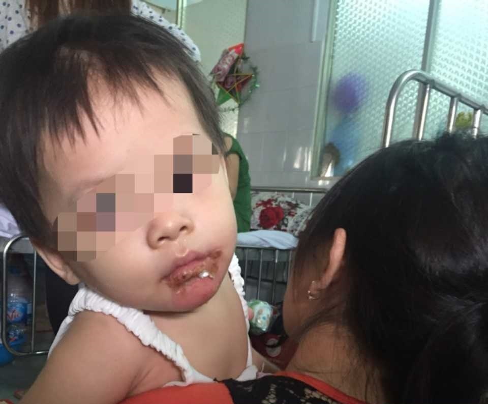 Be gai 18 thang bong nang o mieng, me to do bao mau hinh anh