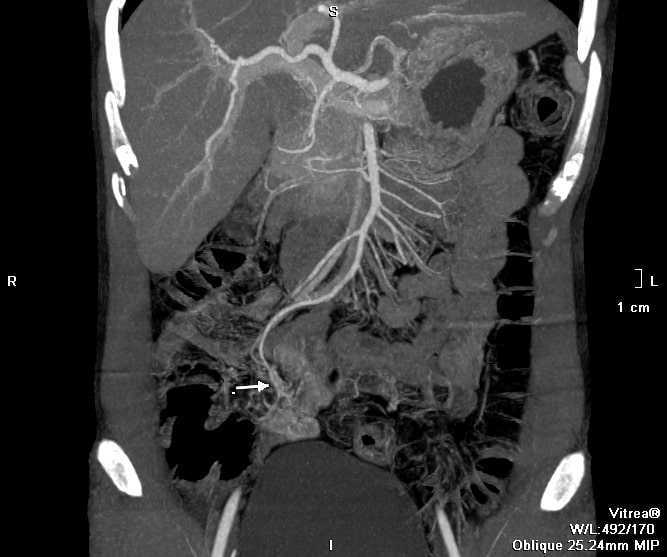 Đi cầu phân đen ảnh 1 Di cau phan den anh 1