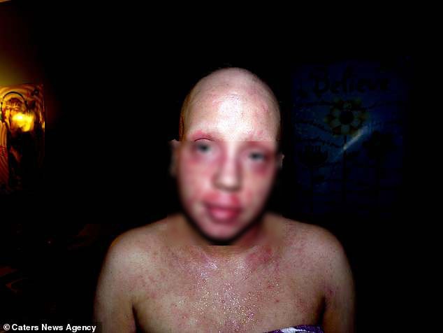 Nghien kem boi tri Eczema, co gai bi goi la quai vat hinh anh