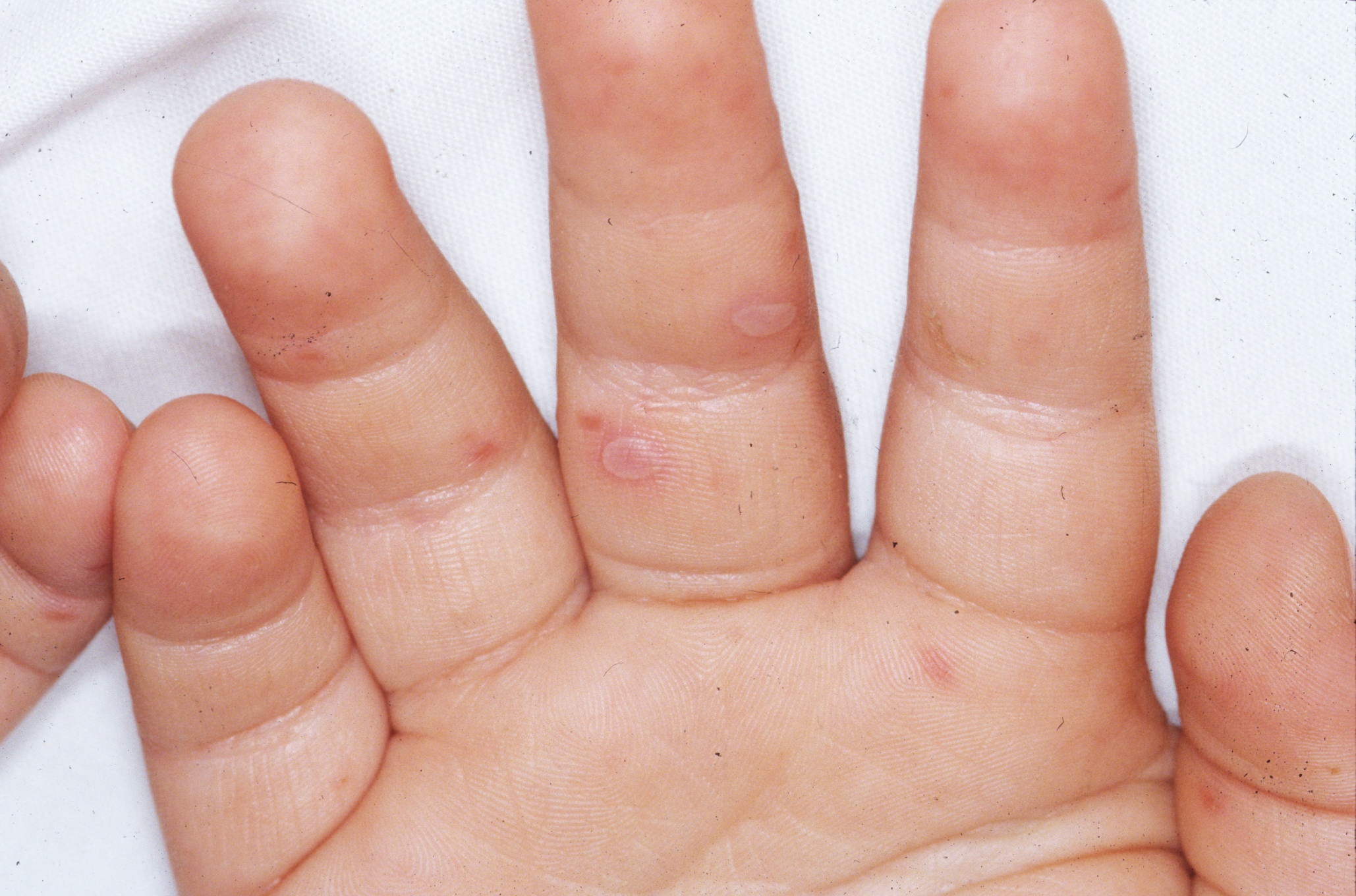 Benh tay chan mieng anh 5