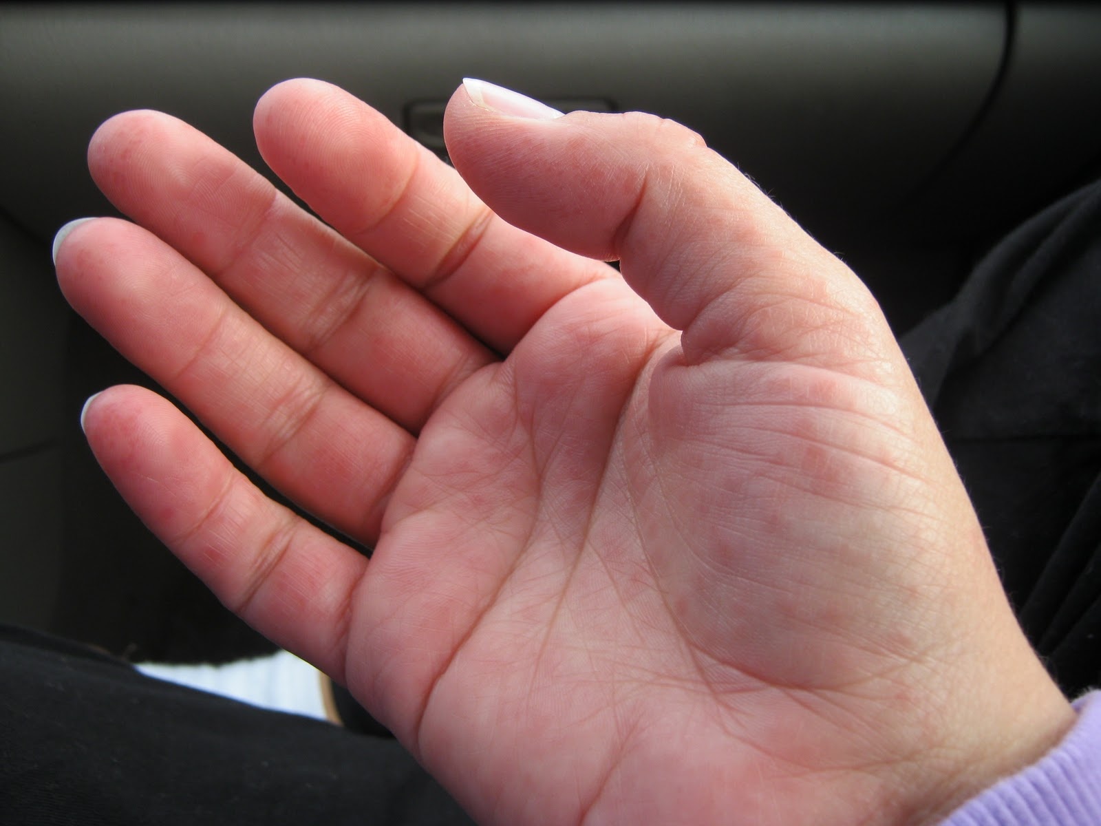 Benh tay chan mieng anh 2