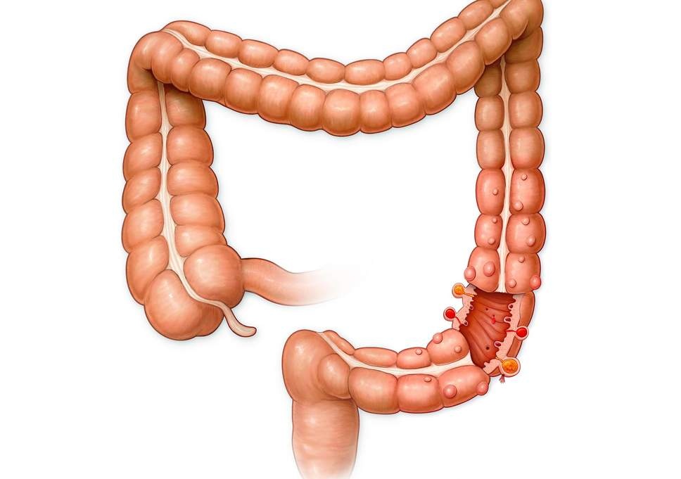 Dấu hiệu viêm ruột thừa ảnh 2 Dau hieu viem ruot thua anh 2