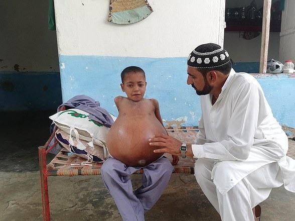 Cau be bi phinh bung vi chung benh hiem gap hinh anh