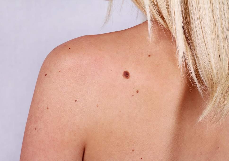 Cach nhan biet not ruoi nguy hiem ban co the tu thuc hien hinh anh