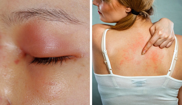 Tac dung phu cua thuoc khang sinh anh 4