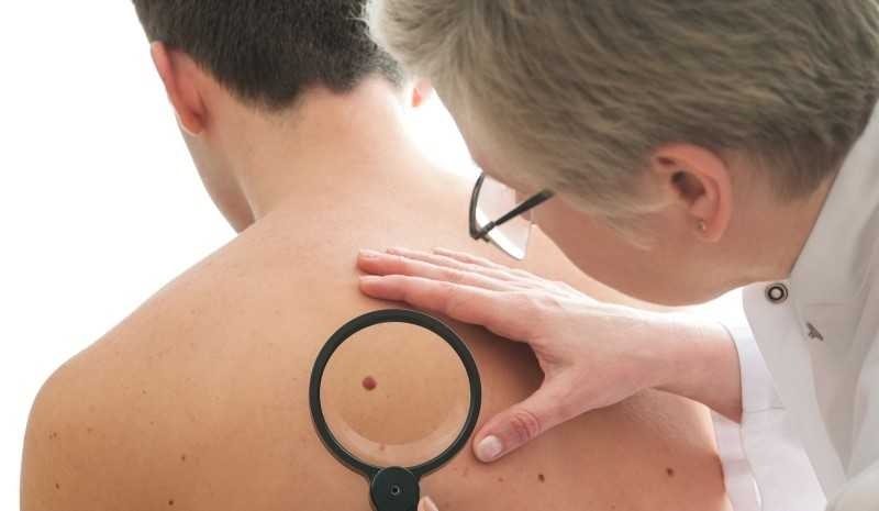 Dan ong tu vong vi ung thu da ngay cang tang hinh anh