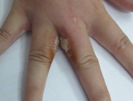 Sai lầm khi tiếp xúc khiến ba khoang ảnh 1 Sai lam khi tiep xuc khien ba khoang anh 1