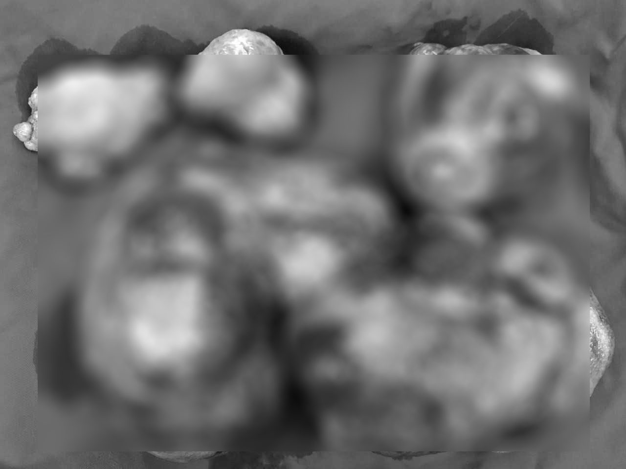 U mạc treo ác tính nặng 3 kg ảnh 2 U mac treo ac tinh nang 3 kg anh 2