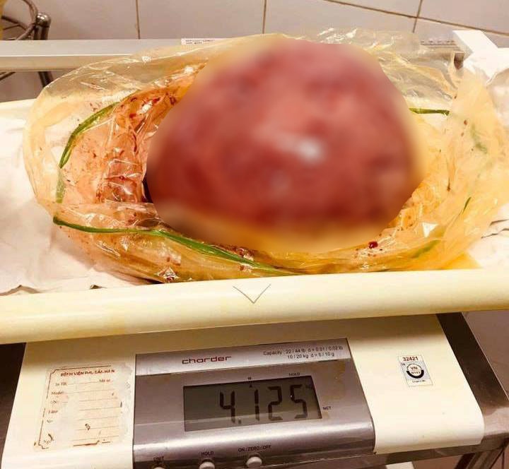 Khoi u xo tu cung to bang thai nhi 9 thang tuoi hinh anh