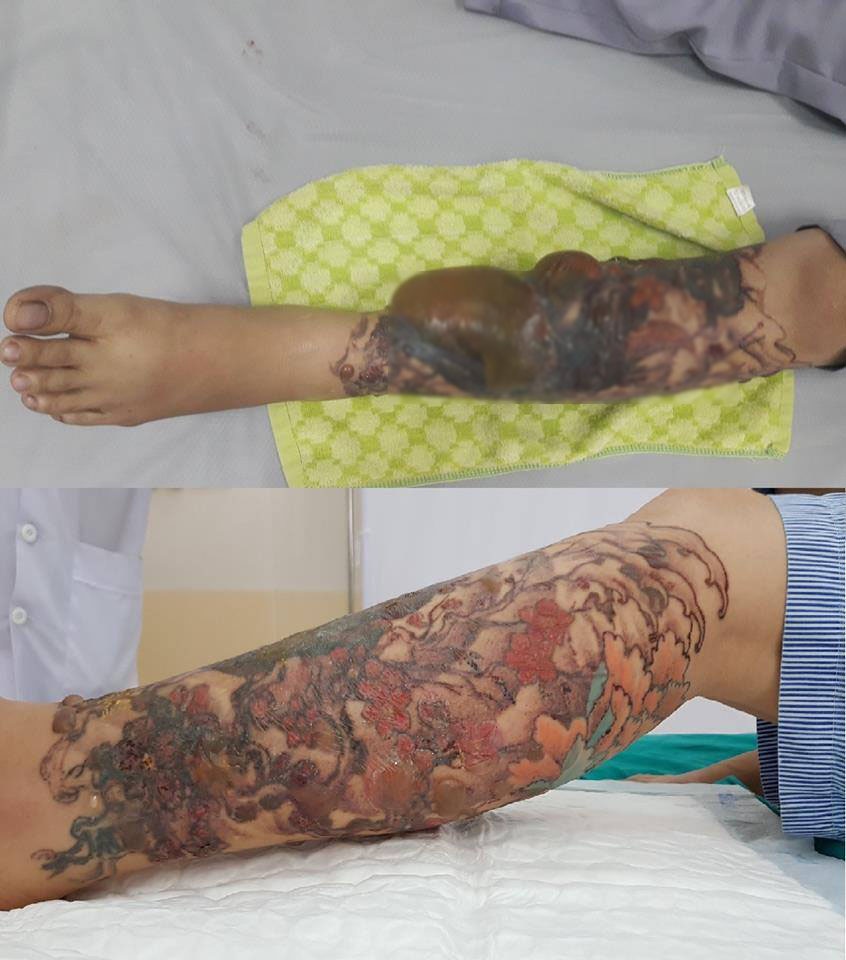 Hoại tử chân vì xóa hình xăm ảnh 1 Hoai tu chan vi xoa hinh xam anh 1
