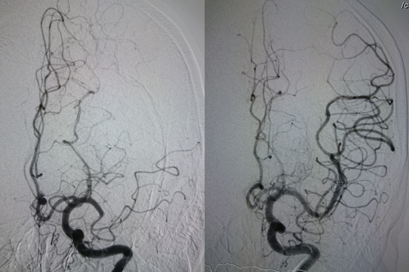Bệnh nhân bị đột quỵ trước Tết ảnh 1 Benh nhan bi dot quy truoc Tet anh 1