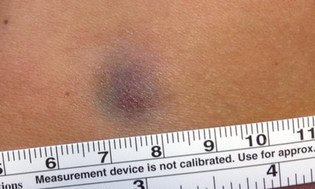 Canh bao ung thu do vet bam tim khong bien mat sau 6 nam hinh anh