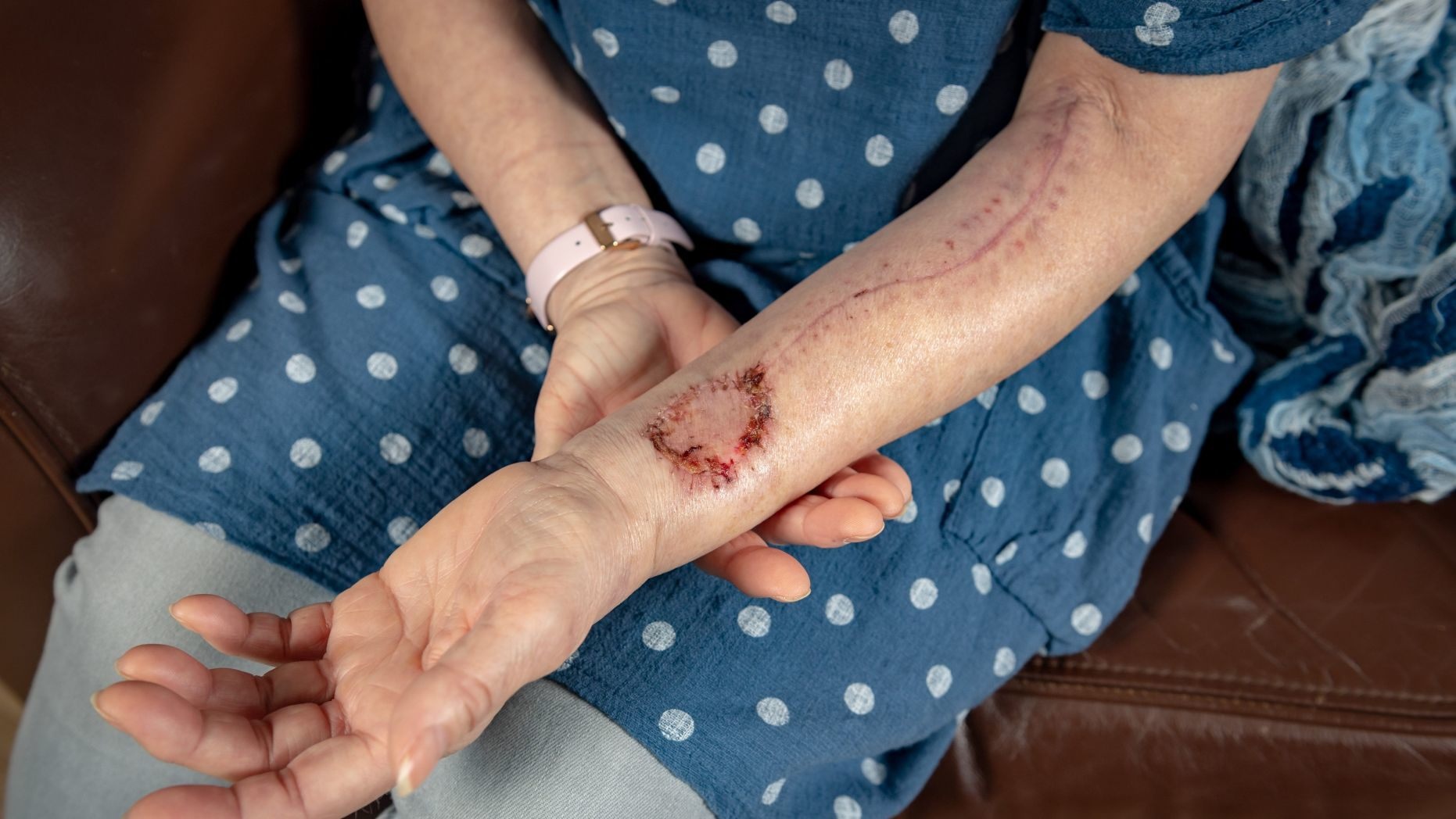 Benh nhan ung thu duoc tao luoi moi tu da va co tay hinh anh