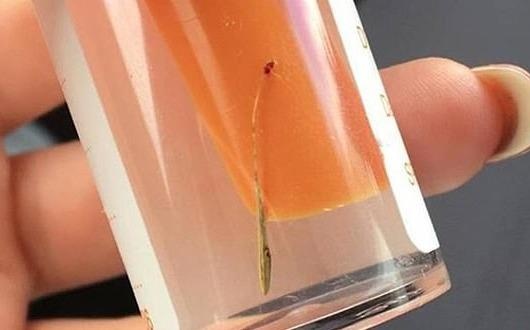 Co dai 3 cm moc trong tai co gai 17 tuoi hinh anh