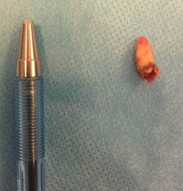 Răng mọc trong mũi ảnh 2 Rang moc trong mui anh 2