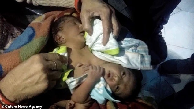 Sinh doi dinh lien anh 1