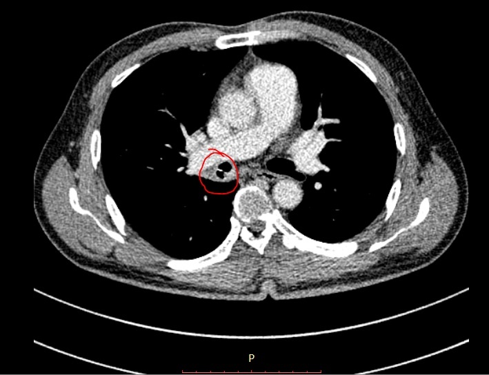 Xương cá mắc trong đường thở ảnh 1 Xuong ca mac trong duong tho anh 1