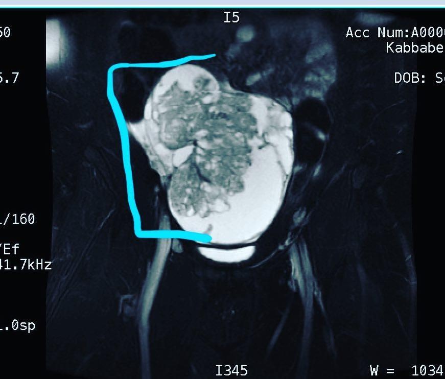 Đau bụng dữ dội vì ung thư buồng trứng ảnh 1 Dau bung du doi vi ung thu buong trung anh 1
