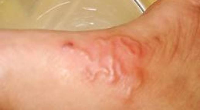 Dau hieu nhiem san lon anh 3