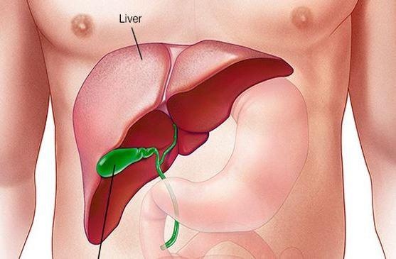 Điều cần biết về bệnh viêm gan ảnh 4 Dieu can biet ve benh viem gan anh 4