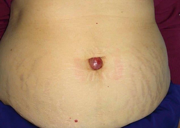 Cuc u mau do ky la o ron - dau hieu canh bao ung thu buong trung hinh anh