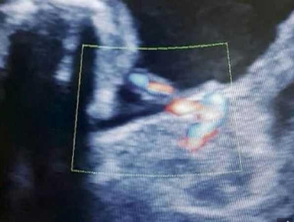 Bao thai vo nao trong bung thai nhi anh 1