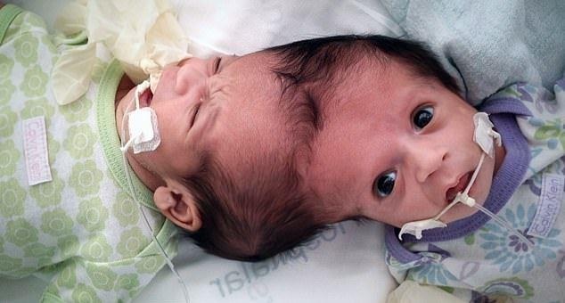 Tach roi cap song sinh dinh lien dau sau 15 gio tren ban mo hinh anh