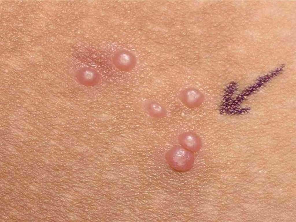 Nguồn lây nhiễm bệnh xã hội ảnh 1 Nguon lay nhiem benh xa hoi anh 1