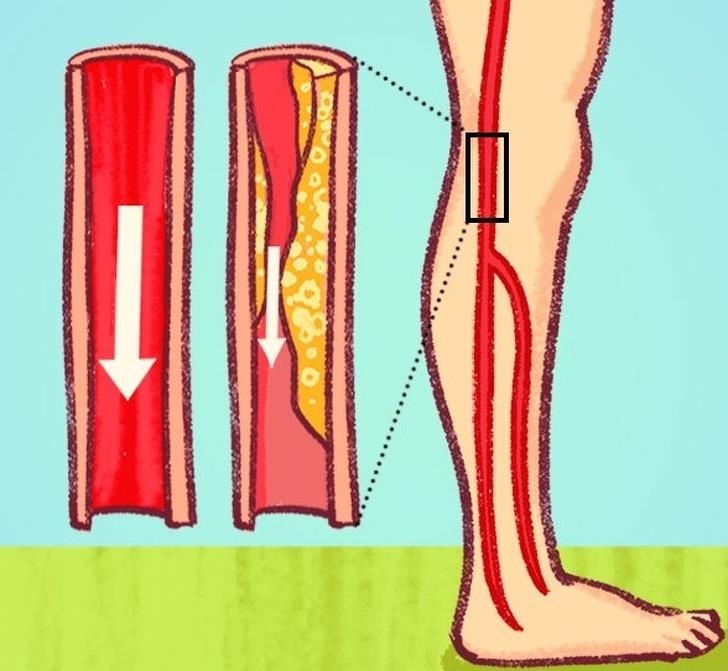 Dau hieu tac dong mach vanh anh 6