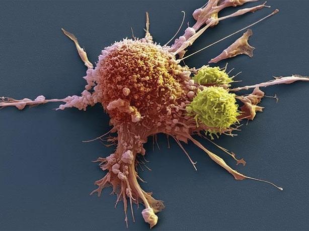 Lieu phap Car-T, hy vong moi cho benh nhan ung thu hinh anh