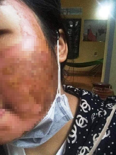 Mat bong axit,  noi mun anh 1