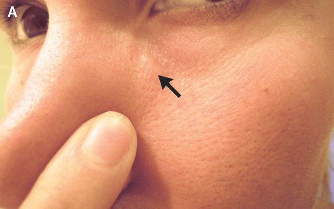 Nguoi dan ong suyt mu vi giun chi dai 15 cm ky sinh trong mat hinh anh