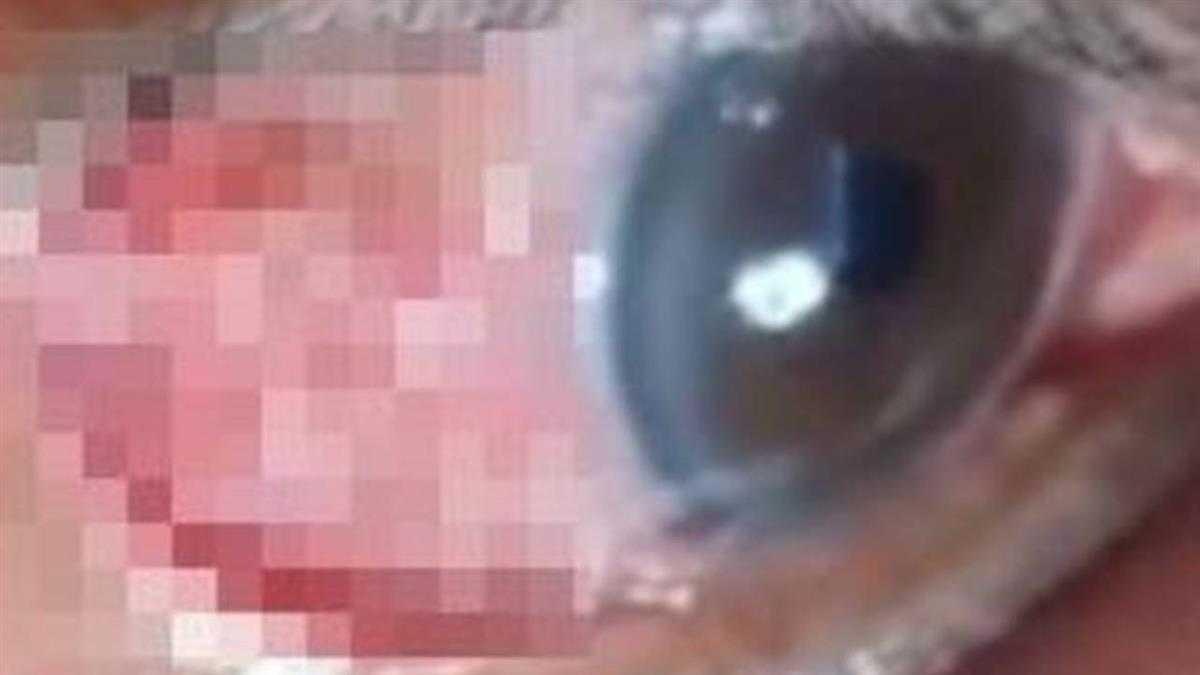 Suyt mu mat vi giun chi ki sinh anh 1