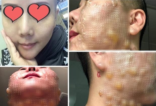 Bỏng độ 2 vì thẩm mỹ căng da bằng siêu âm ảnh 1 Bong do 2 vi tham my cang da bang sieu am anh 1