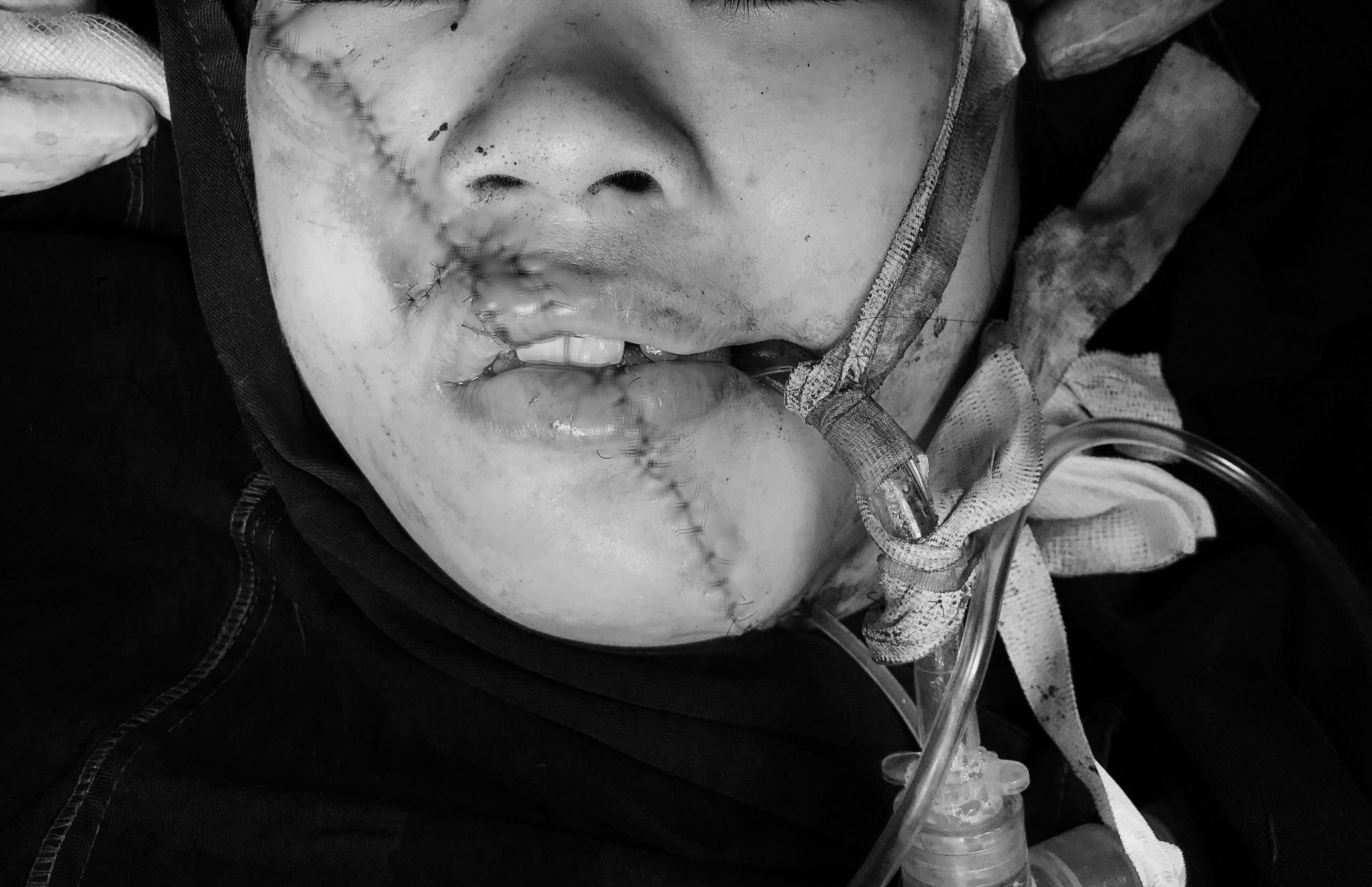 Tái tạo mặt cho người phụ nữ ngã xe máy ảnh 1 Tai tao mat cho nguoi phu nu nga xe may anh 1